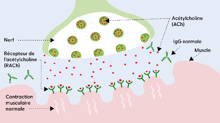 La jonction neuromusculaire en présence de MG